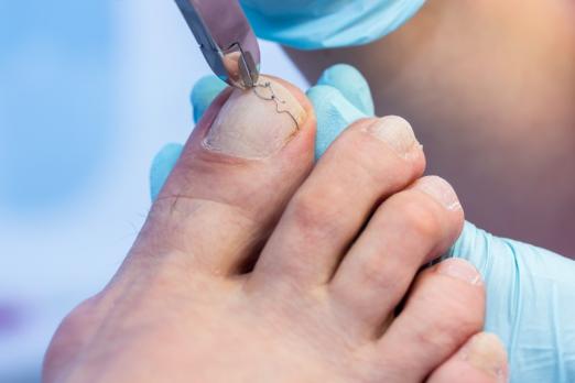 ongle incarné, cors ongle incarné, cors